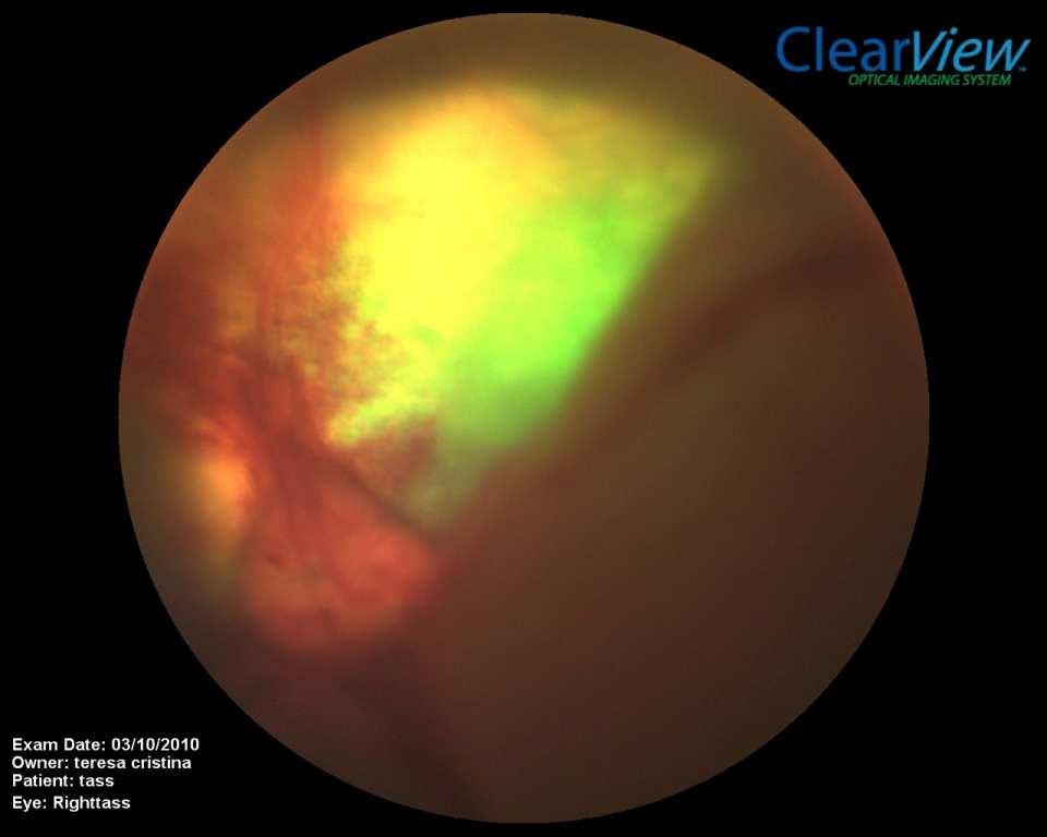 Revisão de literatura processos passivos por difusão aquosa da retina para o vítreo.