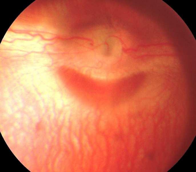 Resultados e discussão o aumento da irrigação da retina e DO é um aspecto fundamental do tratamento do glaucoma, uma vez que, diminui os processos isquêmicos responsáveis pelo déficit visual de