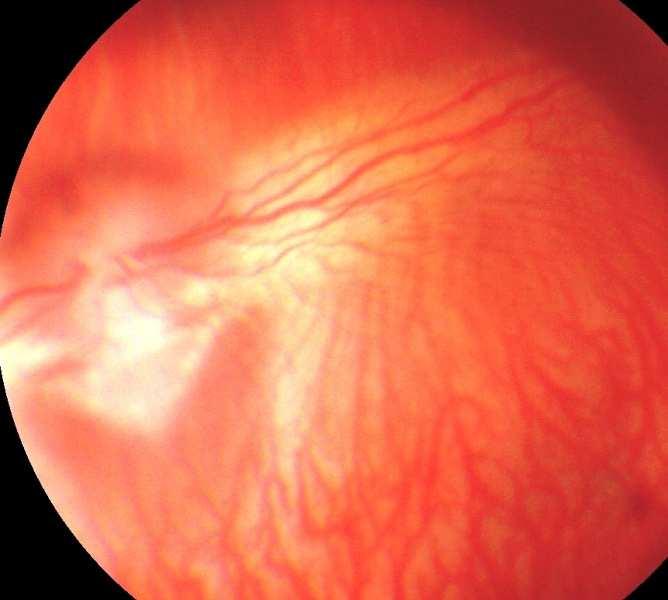 No presente trabalho, não foram observados alterações no padrão vascular da coróide, retina e DO dos animais tratados com MT à oftalmoscopia direta, indireta, biomicroscopia com lâmpada em fenda e