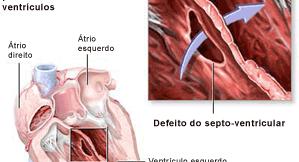 Defeitos congênitos Defeito