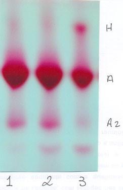 Figura 3. Eletroforese alcalina em acetato de celulose. As amostras 1 e 2 são normais para hemoglobinas (Hb AA) e a de nº 3 pertence a uma pessoa com talassemia alfa (Hb AH). (NAOUM, 20??) 4.