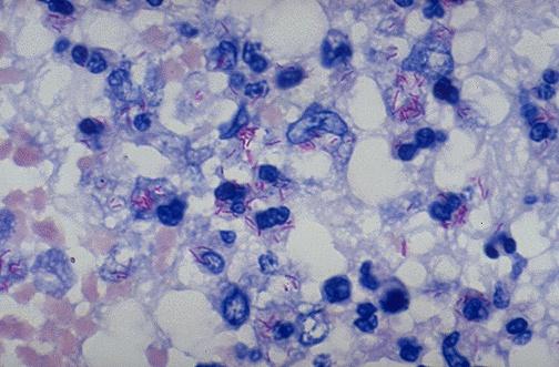 ANÁLISE HISTOLÓGICA Mycobacterium