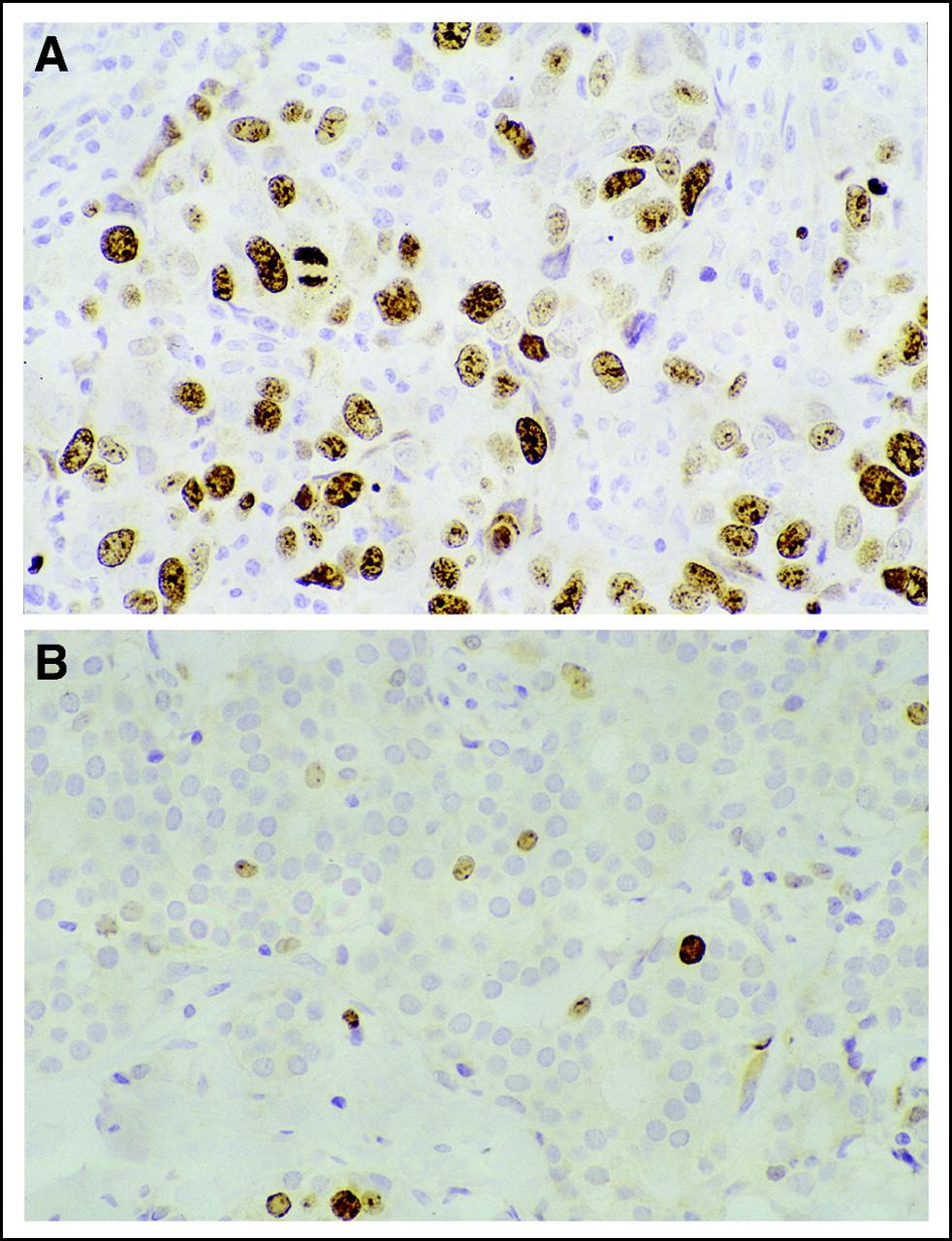 IMUNO-HISTOQUÍMICA Neoplasia de mama