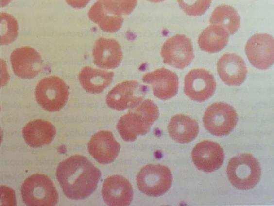 3.2. Plaquetas: São responsáveis por elaborados processos bioquímicos envolvidos na hemostasia, trombose e coagulação do sangue.