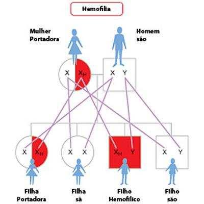 HEMOFILIA: A hemofilia é uma doença hemorrágica que ocorre quase que exclusivamente em indivíduos do sexo masculino.