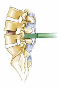 1. Interbody Fusion Lombar A fusão intervertebral é executada, pela preferência do cirurgião, conforme a patologia.