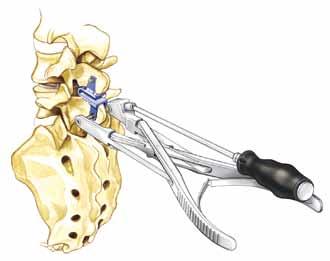 O ligamento interespinhoso é sacrificado e qualquer excesso ósseo do processo espinhal é removido cirurgicamente para que não interfira com a inserção do implante coflex-f. 4.