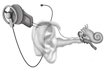 O sistema do implante é composto por um microfone externo que processa a fala, uma antena e dois cabos, que enviam os sinais para o receptor interno (chip) e este, por meio de um cabo formado por