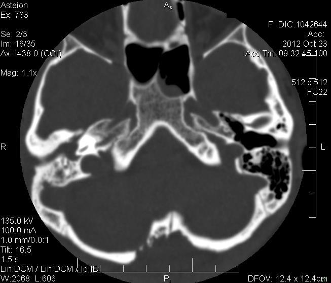Figura 1: Tomografia Computadorizada de região mastoidea realizada no dia 23/10/2012 com verificação de sinais de pansinusopatia e mastoidite à direita; com