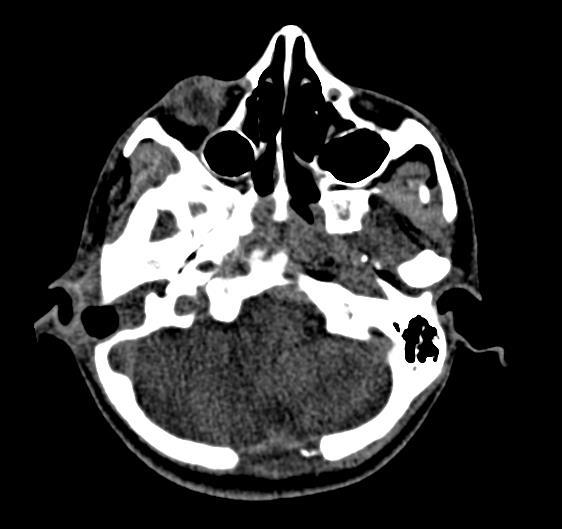 Figura 2: Tomografia Computadorizada de região mastoidea realizada no dia 09/11/2012, mostrando sinais de manipulação cirúrgica da mastóide direita, com perda de