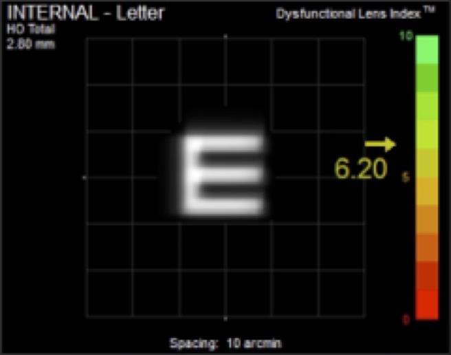 Densitometria do Cristalino Baseada no Princípio de Scheimpflug na Avaliação Pré-Operatória de Cataratas Nucleares imperceptíveis nas medições da acuidade visual.