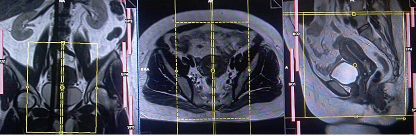 Sagital T2 - Usa-se a imagem axial para este planejamento; -O bloco de aquisição deverá estar perpendicular ao sacro; - Na imagem coronal as linhas devem ficar paralela