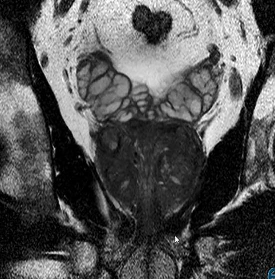 Coronal