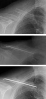 As incisões para a colocação dessas hastes são geralmente menores que as realizadas para colocar as placas.