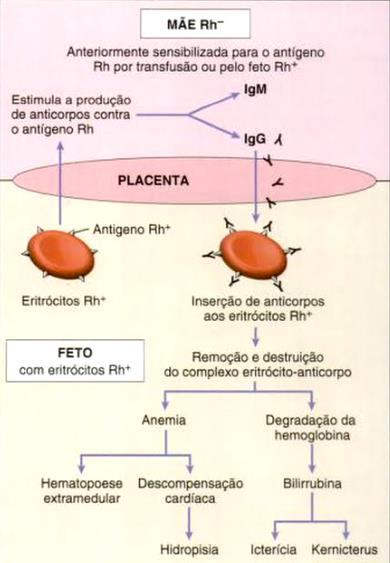 19 pressão oncótica e se instale uma insuficiência cardíaca e hidropisia fetal (BAIOCHI, 2009). Figura 2 - Esquema do Desenvolvimento da DHRN Fonte: ROBBINS & COTRAN, 2005, p.