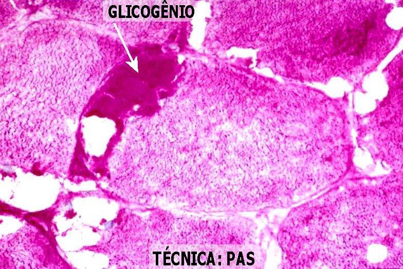 Glicogenoses Doenças genéticas, caracterizadas pelo acúmulo de glicogênio nas células do fígado, rim, músculos esqueléticos e coração, que tem como causa base a deficiência de enzimas que atuam no