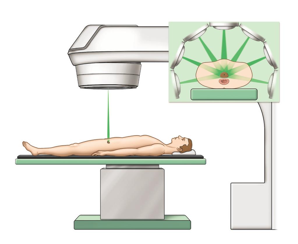 Posições possíveis da máquina Máquina Próstata Reto Feixe de radiação Fig 4b: O feixe de radiação é direcionado para a próstata a partir de diferentes ângulos. Próstata Fig.