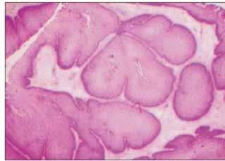 Em termos histológicos apresenta um padrão de crescimento endofítico do epitélio superficial para o interior do estroma adjacente com alterações polipoides da mucosa nasal 2 (Figura 2).