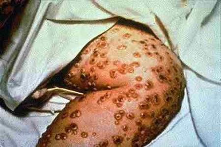 Varíola doença infecto-contagiosa