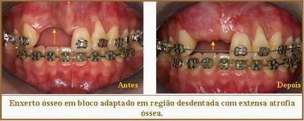 Consegue ampliar a altura e a espessura do osso para