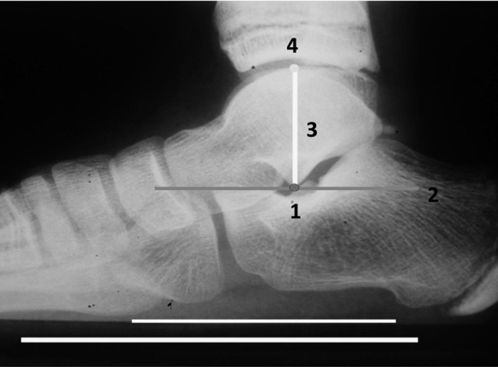 296 Figura 3 Ilustração da mensuração da altura talar (explicação no texto). Figura 5 Ilustração do cálculo do grau de subluxação do navicular (explicação no texto).