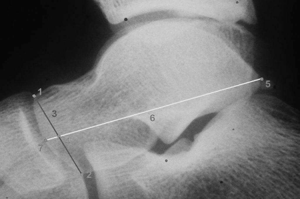 A distância do ponto 5 ao ponto 7 constitui o comprimento do tálus. Foi realizada a mensuração da altura e do comprimento no pé acometido e no contralateral.