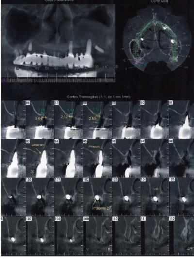 Figura 2 Tomografia: corte panorâmico, corte axial e parassagital região