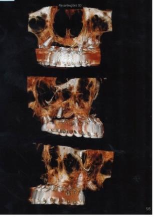 Figura 3 Tomografia maxila esquerda e direita: reconstrução em 3D, da maxila total e corte axial. Fonte: Gottardo (2016). Figura 4 - Tomografia maxila esquerda reconstrução 3D corte axial.