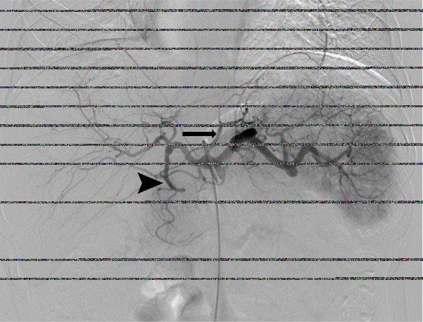 INTRODUÇÃO Angiograma do tronco celíaco Anatomia