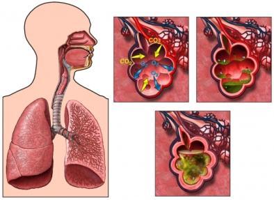 Doença pulmonar (90%) Perda progressiva da função pulmonar Tosse crônica Lactente chiador