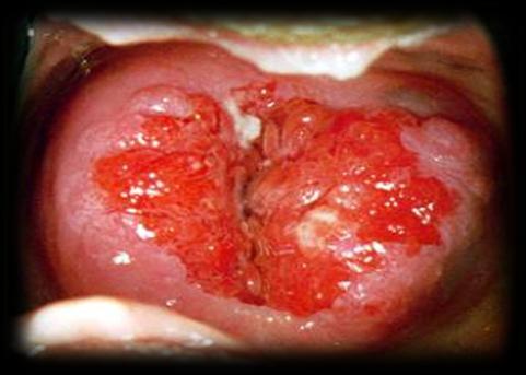 Chlamydia trachomatis Sintomas: Assintomática; Alterações inflamatórias