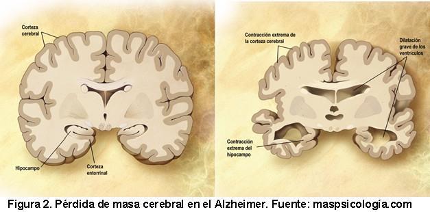 O cérebro idoso: alterações anatômicas a) tamanho e peso menores, b) giros mais finos separados por sulcos mais abertos e profundos o que resulta em regiões corticais menores em comparação a cérebros