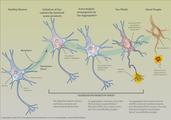 Histopatologia da Doença de Alzheimer Emaranhado Neurofibrilar Placa