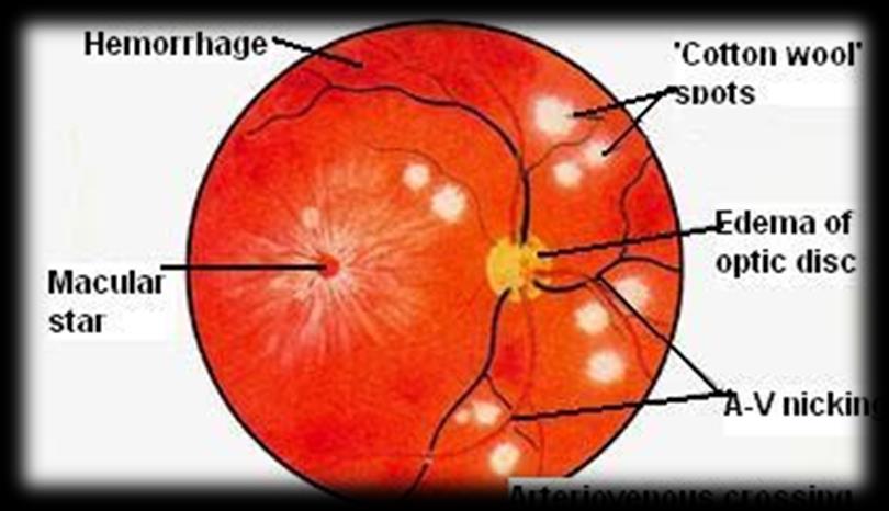 RETINOPATIA HIPERTENSIVA Escotoma Diplopia Fotópsia Diminuição da acuidade visual HEMORRAGIAS EXSUDADOS ALGODONOSOS