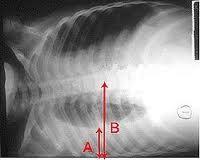 pleural