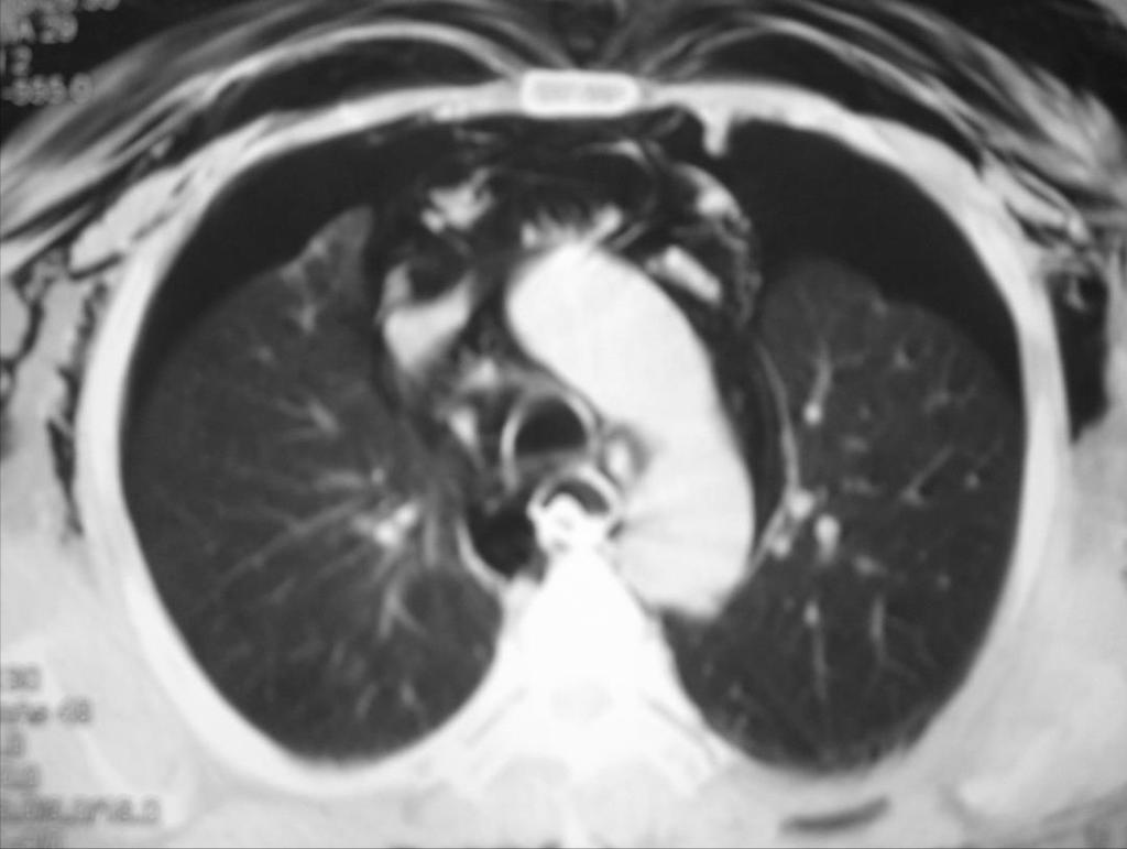 Trauma torácico Lesões pulmonares. Lesões do mediastino.