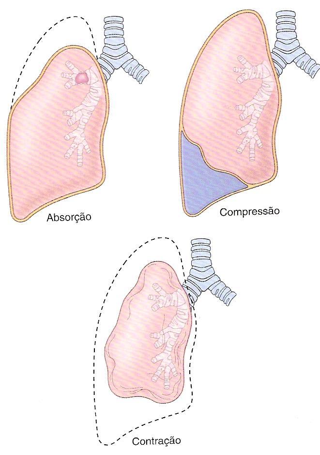 Atelectasia (colapso pulmonar) É a perda de volume pulmonar causada por uma expansão inadequada dos espaços aéreos. Classificação da Atelectasia: 1.
