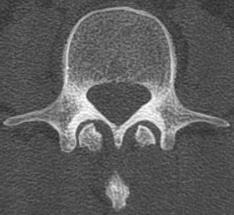 vertebral Corpo vertebral