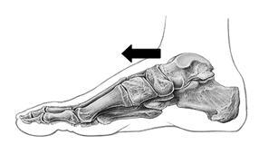 Representação esquemática da disfunção de anterioridade do talus Ao teste de mobilidade o talus não posterioriza.