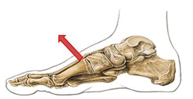 Representação esquemática da disfunção de superioridade do 1º metatarso Paciente pode referir dor: - no mediopé ou no hálux, - ao caminhar sobre o bordo medial do pé e - nos movimentos de eversão.