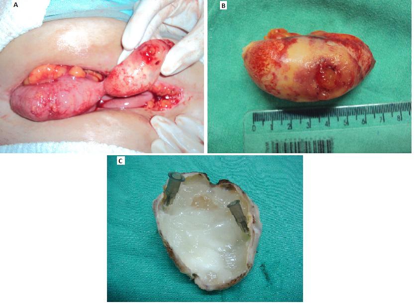 Figura 2. A - Achado operatório. B Peça cirúrgica fechada. C Peça cirúrgica aberta (autoria própria). 2 A); pelve sem implantes; útero e anexos normais.