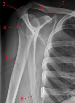 Radiografia do ombro: incidência perfil 1 Processo coracóide.