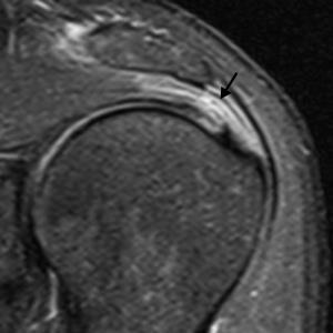 Sindrome do impacto Tendinopatia do supra espinhal Cortes coronais (posterior para anterior),