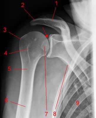 Radiografia do ombro: incidência AP (frontal). 1, Clavícula. 2, Acrômio. 3, Tuberosidade maior do úmero.