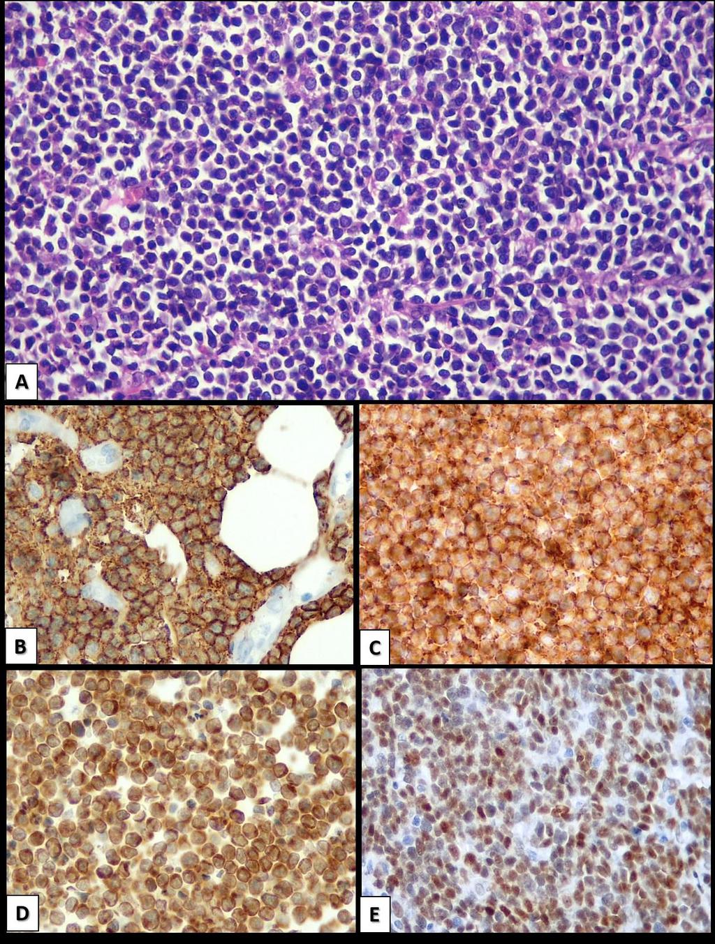 Figura 3: Exemplo de linfoma de grandes células B de alto grau. Notar a monotonia das células neoplásicas, de tamanho médio (A, HE).