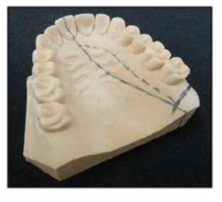 49 Figura 6 Delimitação do modelo de gesso para recorte do arco dentário 124. 4.