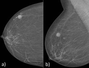 BI-RADS - Achados Mamográficos NODULOS: Deve ser identificado