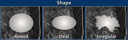 BI-RADS - Achados Mamográficos NODULOS: Forma