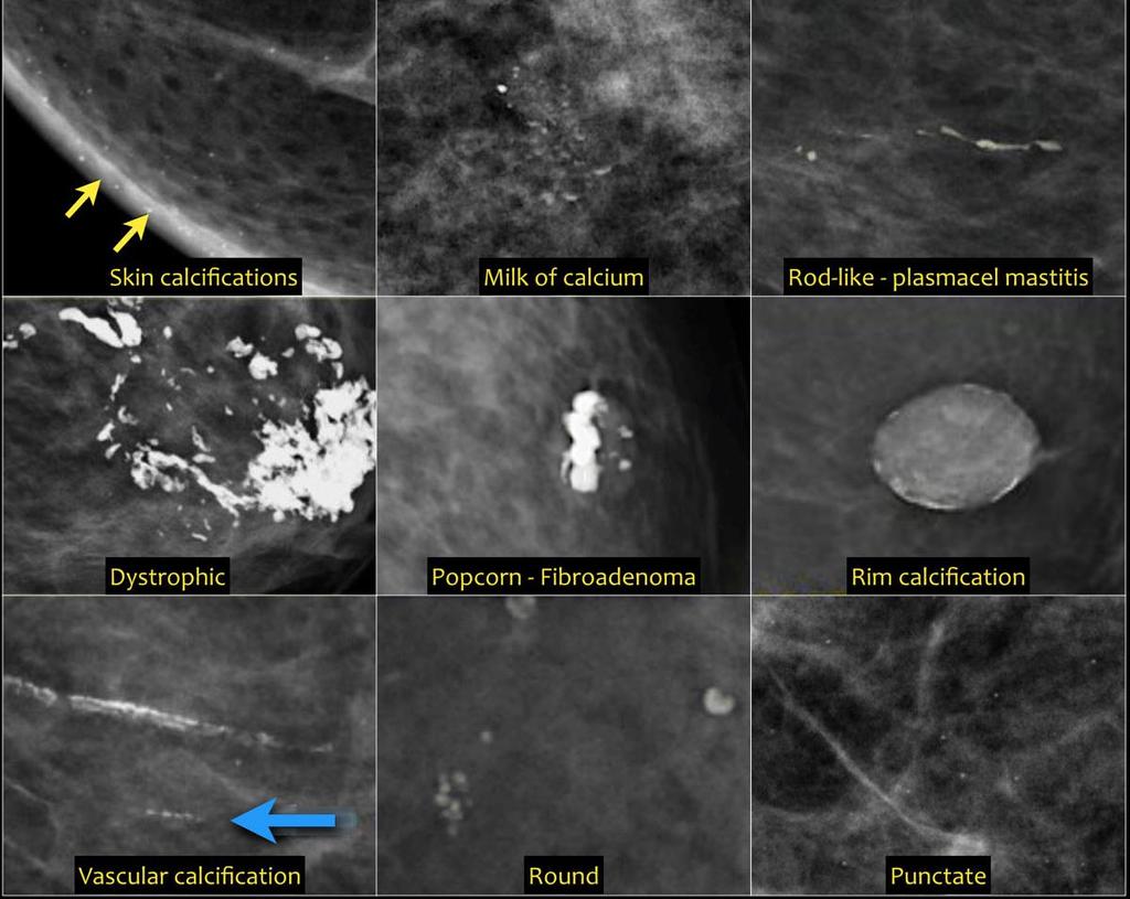 BI-RADS - Achados Mamográficos CALCIFICAÇÕES: TIPICAMENTE BENIGNAS: - Cutâneas - Vasculares - Grosseiras / em pipoca - Redondas /