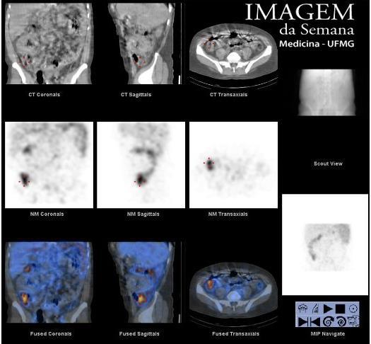 Imagem 2: Análise da Imagem 2: Cintilografia com 99m Tc-PYP (SPECT) + CT evidenciando concentração do radiofármaco na projeção da região ileocecal, com progressão para cólon ascendente.